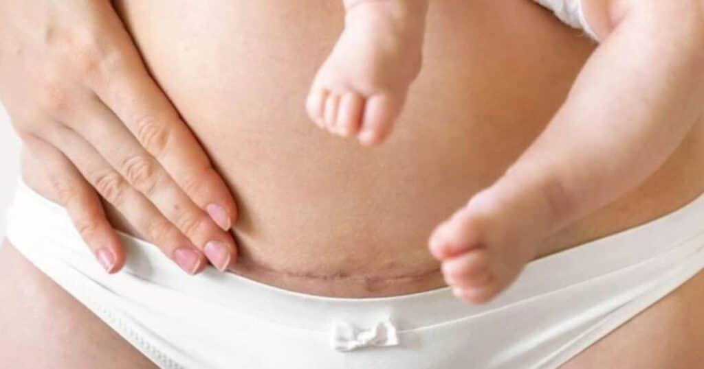 postpartum mom after cesarean birth with scar, holding baby and showing belly