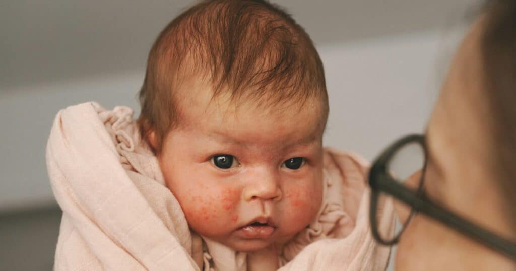 newborn baby with acne